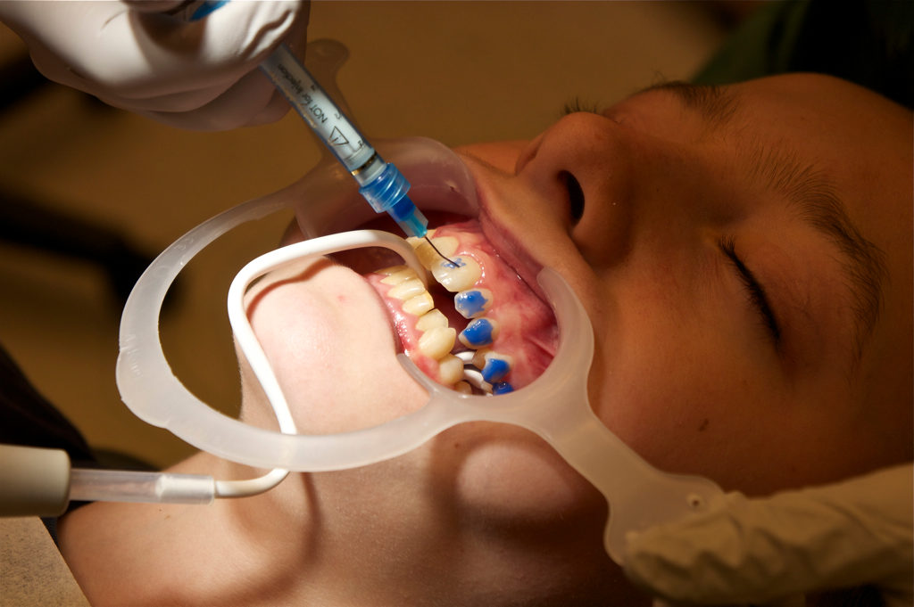 Why Some People Whiten Their Teeth