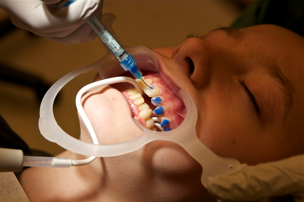 Why Some People Whiten Their Teeth