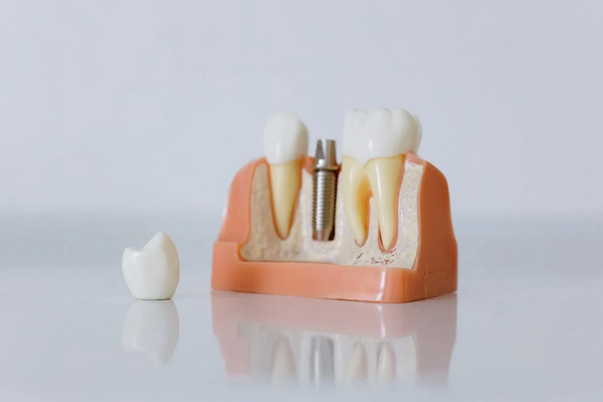 Are You a Candidate for Dental Implants? Factors to Consider